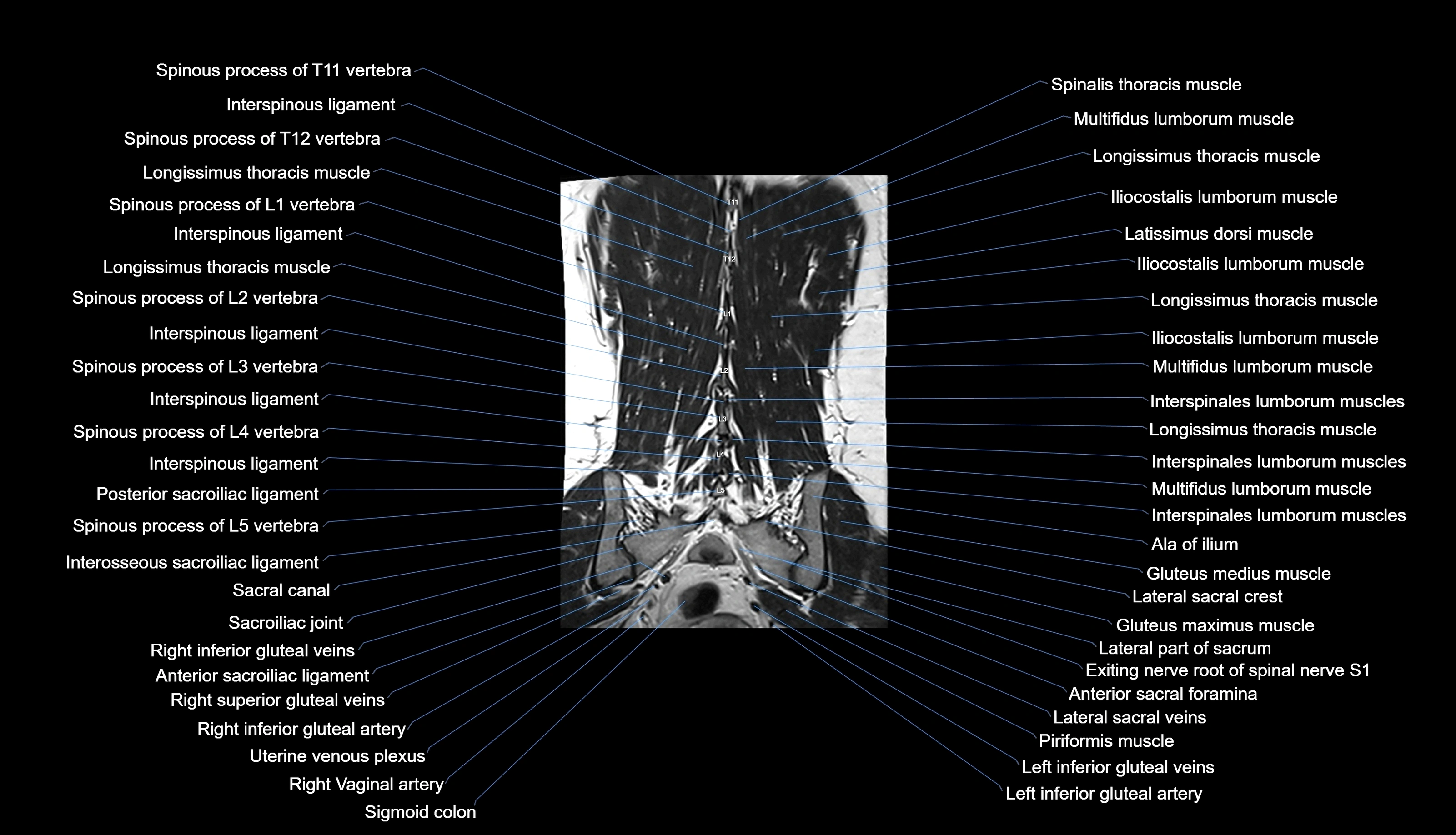 MRI lumbar spine labelled coronal cross sectional anatomy 3T radiology-img-00001-00029.webp